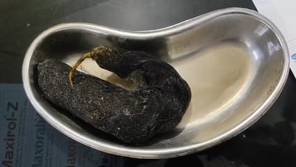 महिला के पेट से निकला बाल