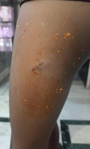 Two people were bitten by dogs in Faizullahganj
