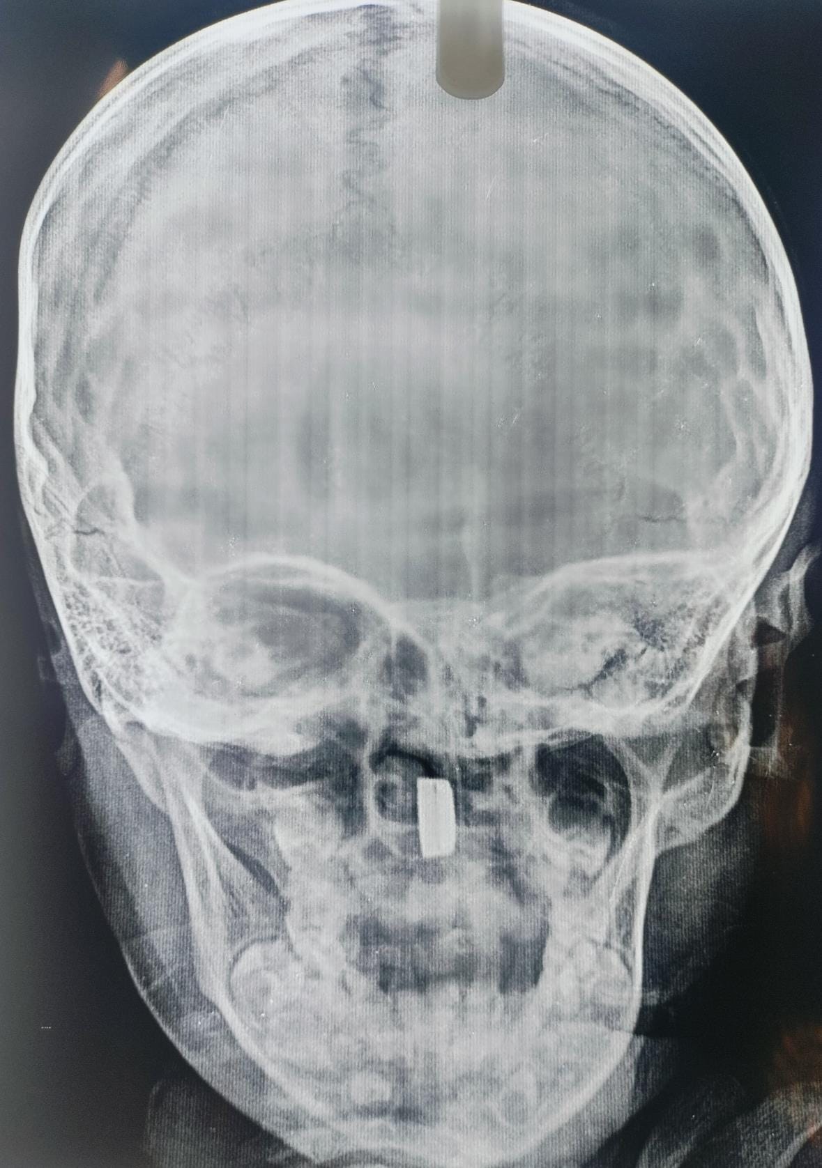 Button battery stuck in innocent child's nose, doctor gives new life