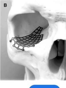 Successful operation of broken bones of jaw and below left eye