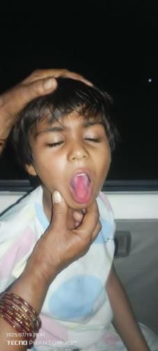 Girl drank caustic soda mistaking it for water, her health deteriorated