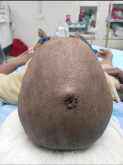 The young man hit a nail in his head, his life was saved in the hospital