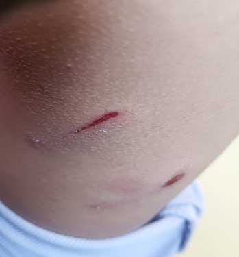 Monkeys injured a nine year old girl
