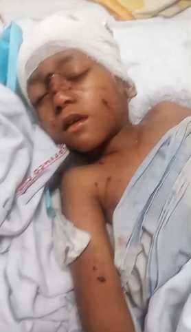 10 stray dogs mauled a 7 year old boy, ate away the skin of half of his head