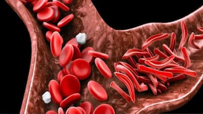 Banswara News: 29 Crore Spent on Sickle Cell in Tribal Rajasthan, 2,735 Identified, MP Urges Wider Testing