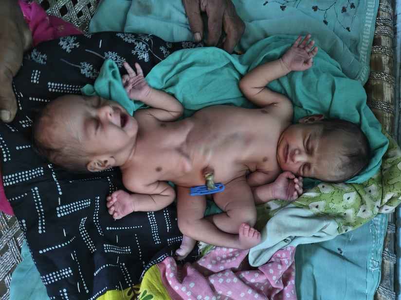 Muzaffarpur Bihar news :rare baby girl was born in skmch medical hospital doctor says its rare