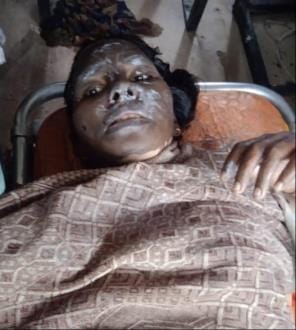 Woman burnt under suspicious circumstances, condition critical