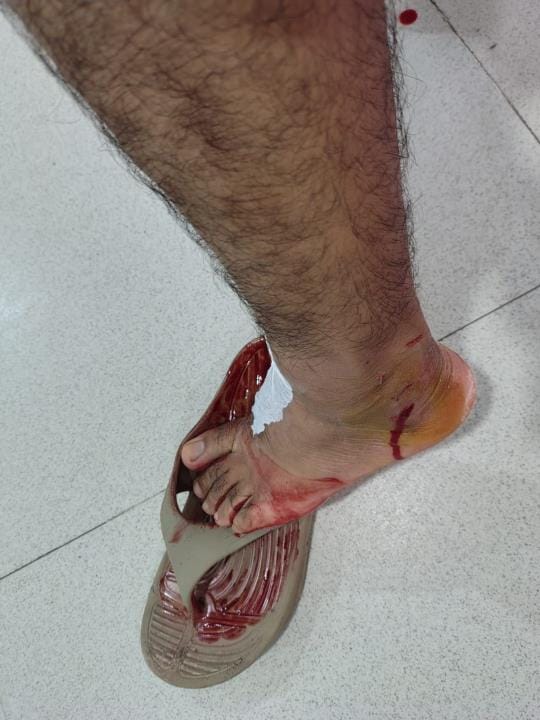 Two injured in stray dog attack, people chased them away and saved their lives