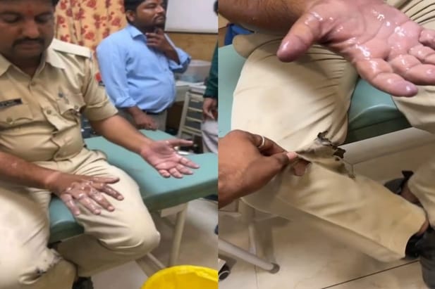 Jaisalmer: Youth started drinking acid after quarrel with wife when constable stopped him both hands got burnt