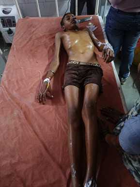 Supply was started during flood, four people got burnt due to transformer explosion