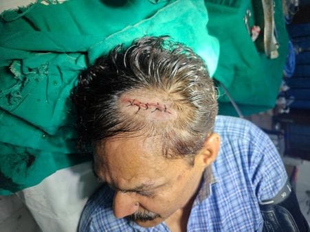 SDO got caught in a landslide while trying to clear the road, seriously injured