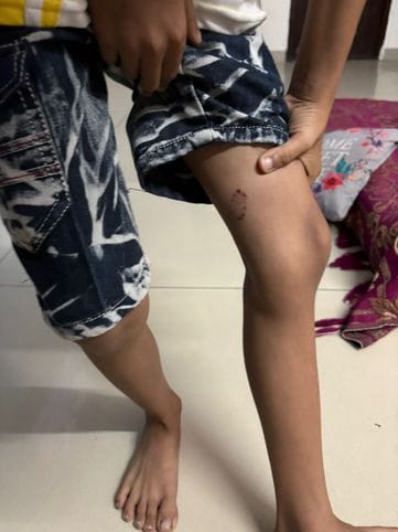 An eight-year-old child was bitten by a dog