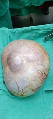 A six kilo lump was removed from the stomach of a young woman and she was given life