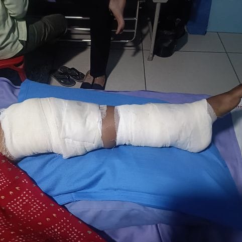 A monkey bit a woman, breaking her leg after falling from a roof.