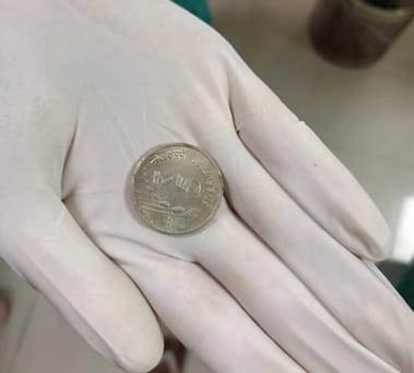 shivpuri-46 / 5,0008-year-old boy swallows a coin while playing
