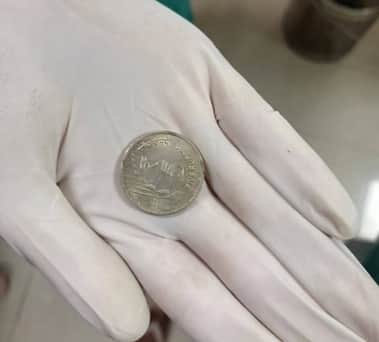 बच्चे के गले से निकाला गया सिक्का