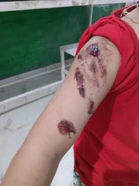 A dog bit the hand of a four-year-old girl in Sainj village.