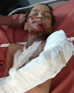 Three children were burnt in an explosion while grinding sulphur potash.