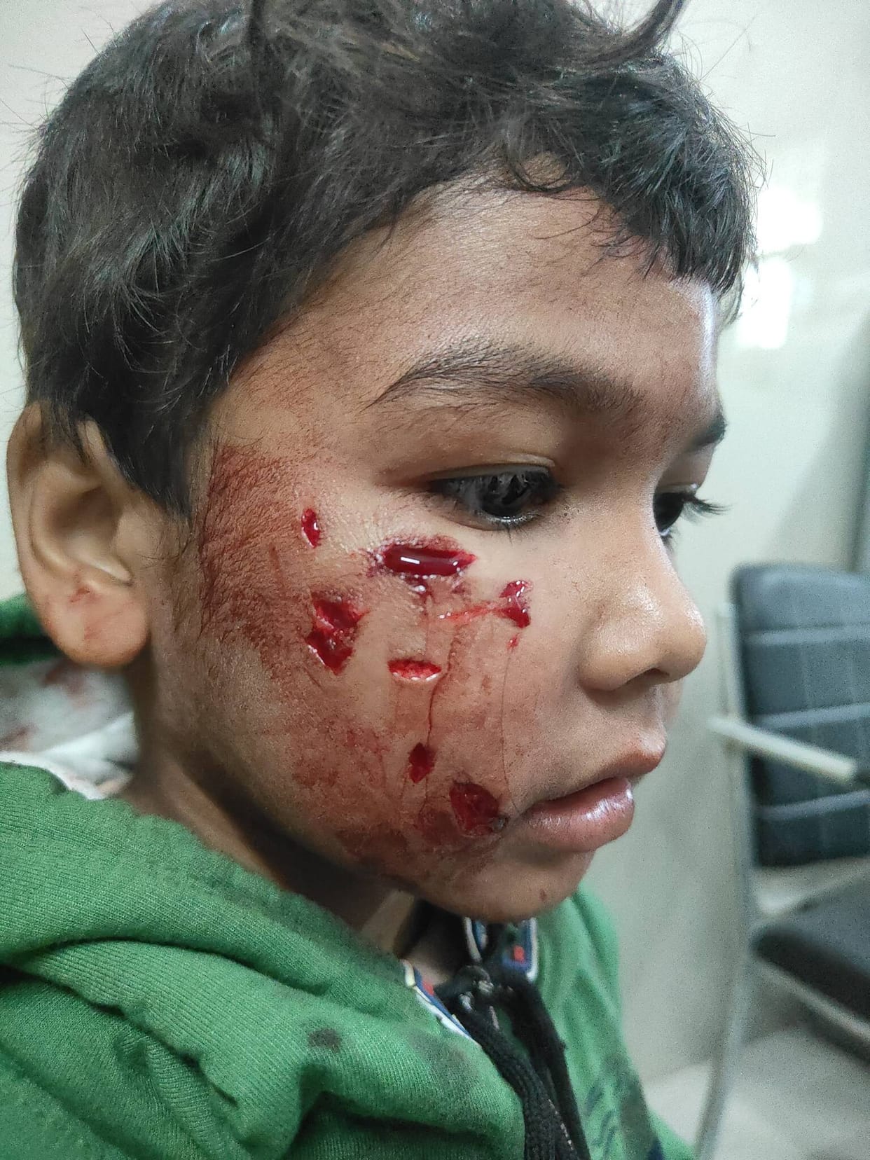 Two children were injured by dogs