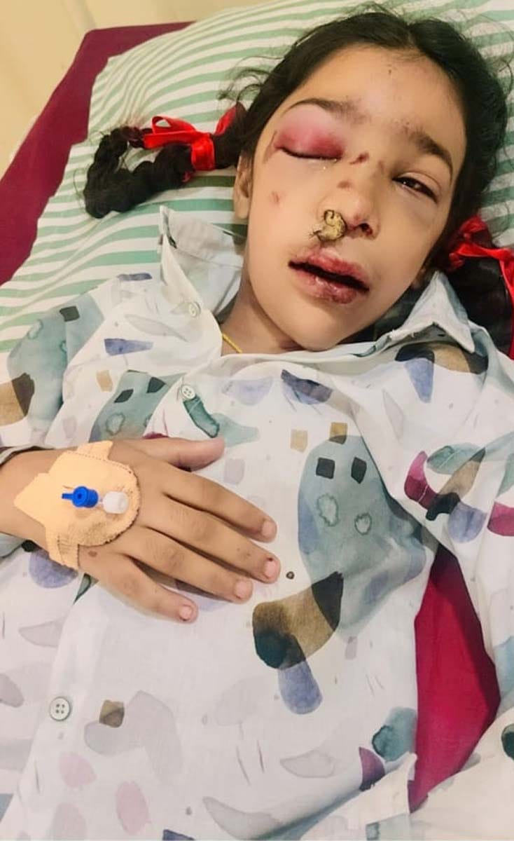 Student who fell from van undergoes jaw surgery, wire inserted in elbow