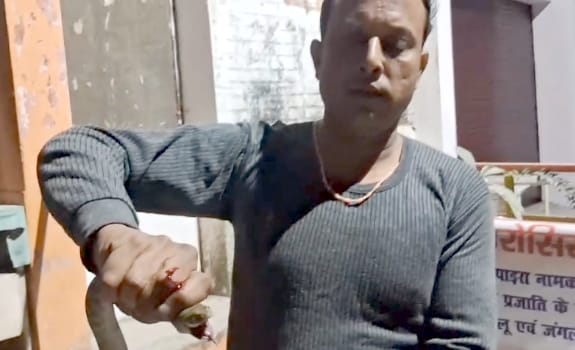 The victim reached the hospital with the snake bite