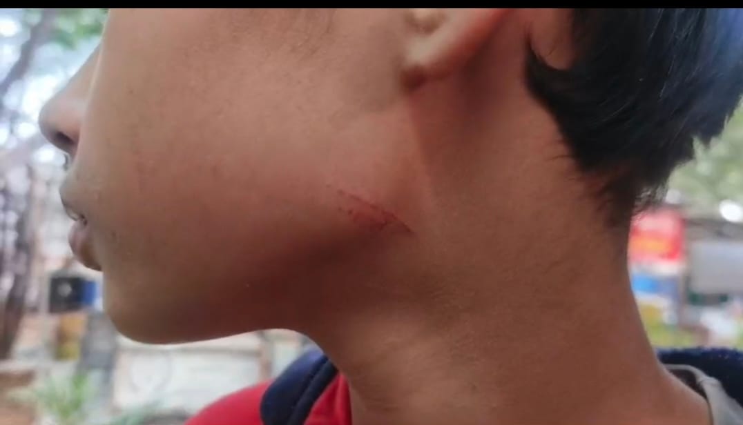 Teacher beats student with an iron scale for making noise in class, leaving marks on cheek and leg