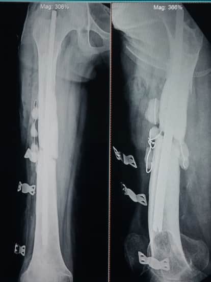 There was an infection in the thigh bone, relief was given by special technique