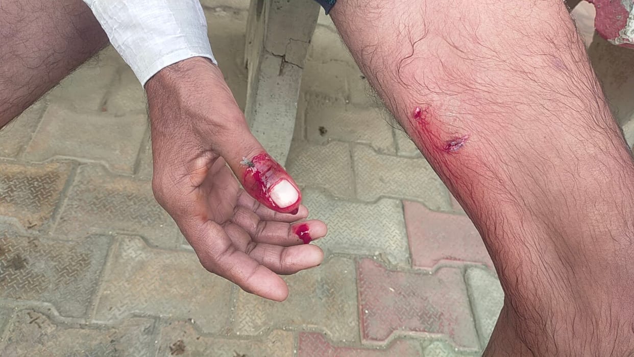 Mad dog terror in Chelawas, two people including a woman were bitten