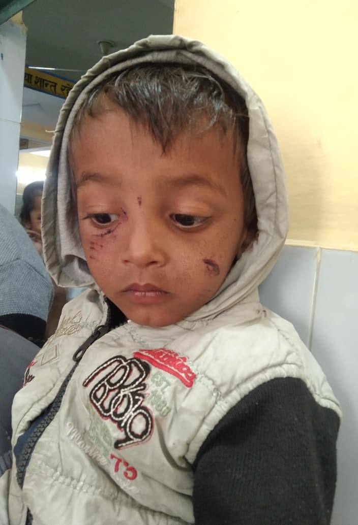 Three-year-old boy bitten on face by dog