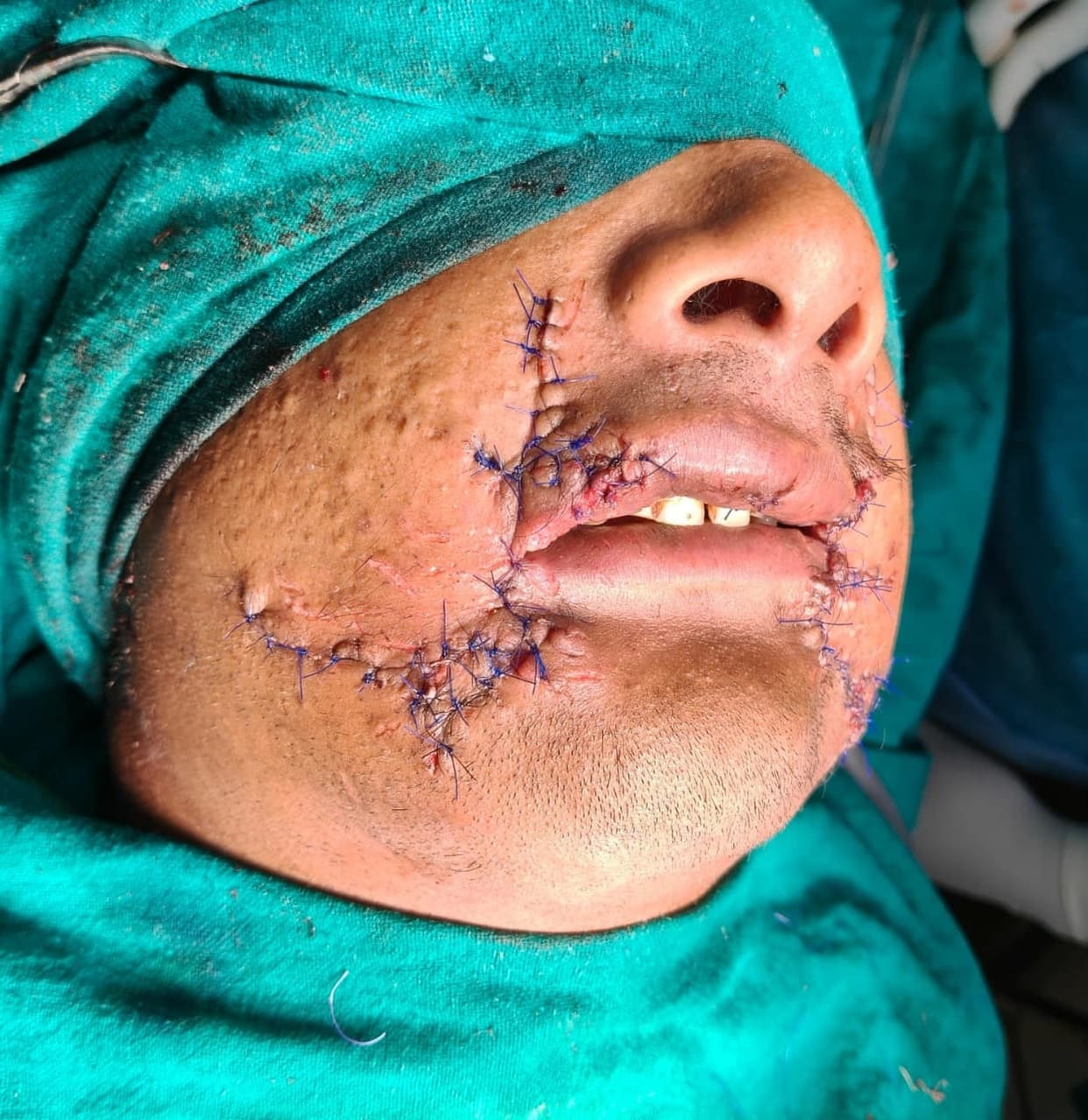 His face was blown off by a firecracker; a 7.5-hour surgery gave him a new face.