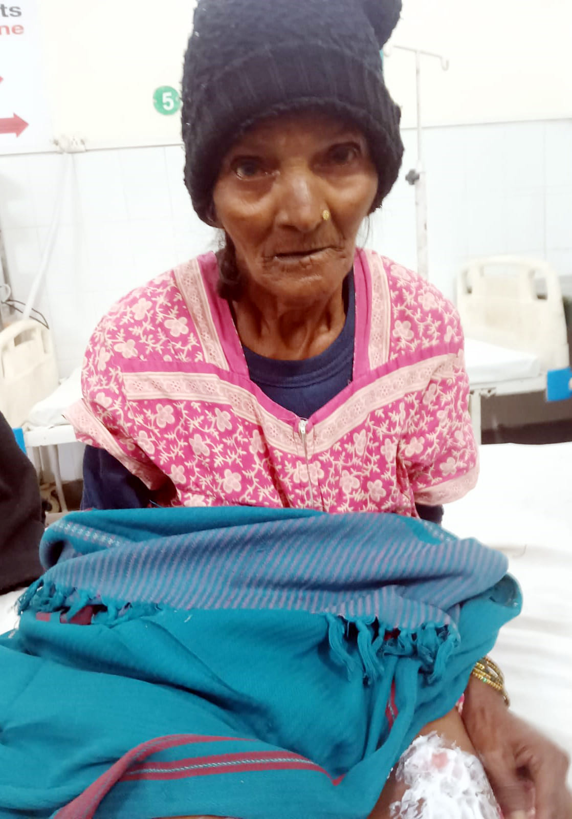 Both the legs of the old woman who was warming herself by the fire got burnt.