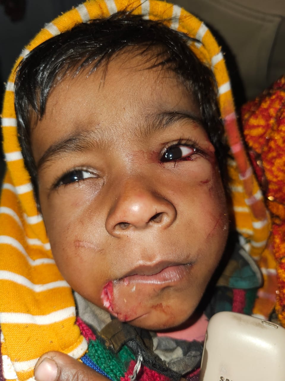 A seven-year-old child's mouth, eyes, and cheeks were mauled by a dog.