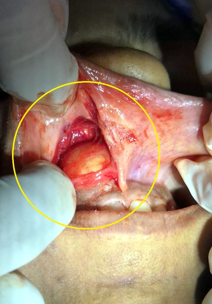A 5.5 cm tumor was successfully removed from the young woman's jaw through surgery