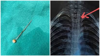 pin from hijab got stuck in girl windpipe requiring an endoscopy  Kota