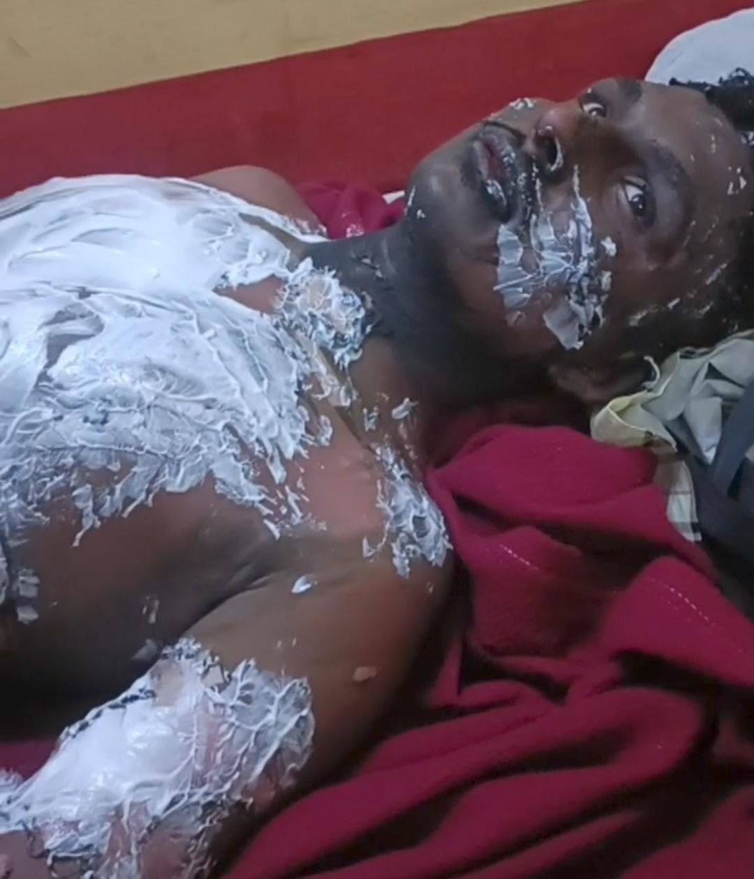 Student doing chemistry practical at home gets burnt by chemicals