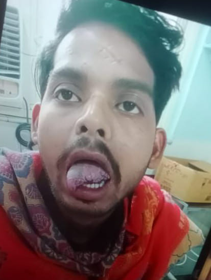 After a dispute, she bit her husband's tongue, his condition is serious