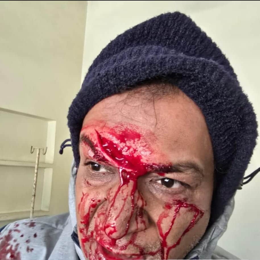 चीनी मांझे से घायल बाइक सवार आशु। 