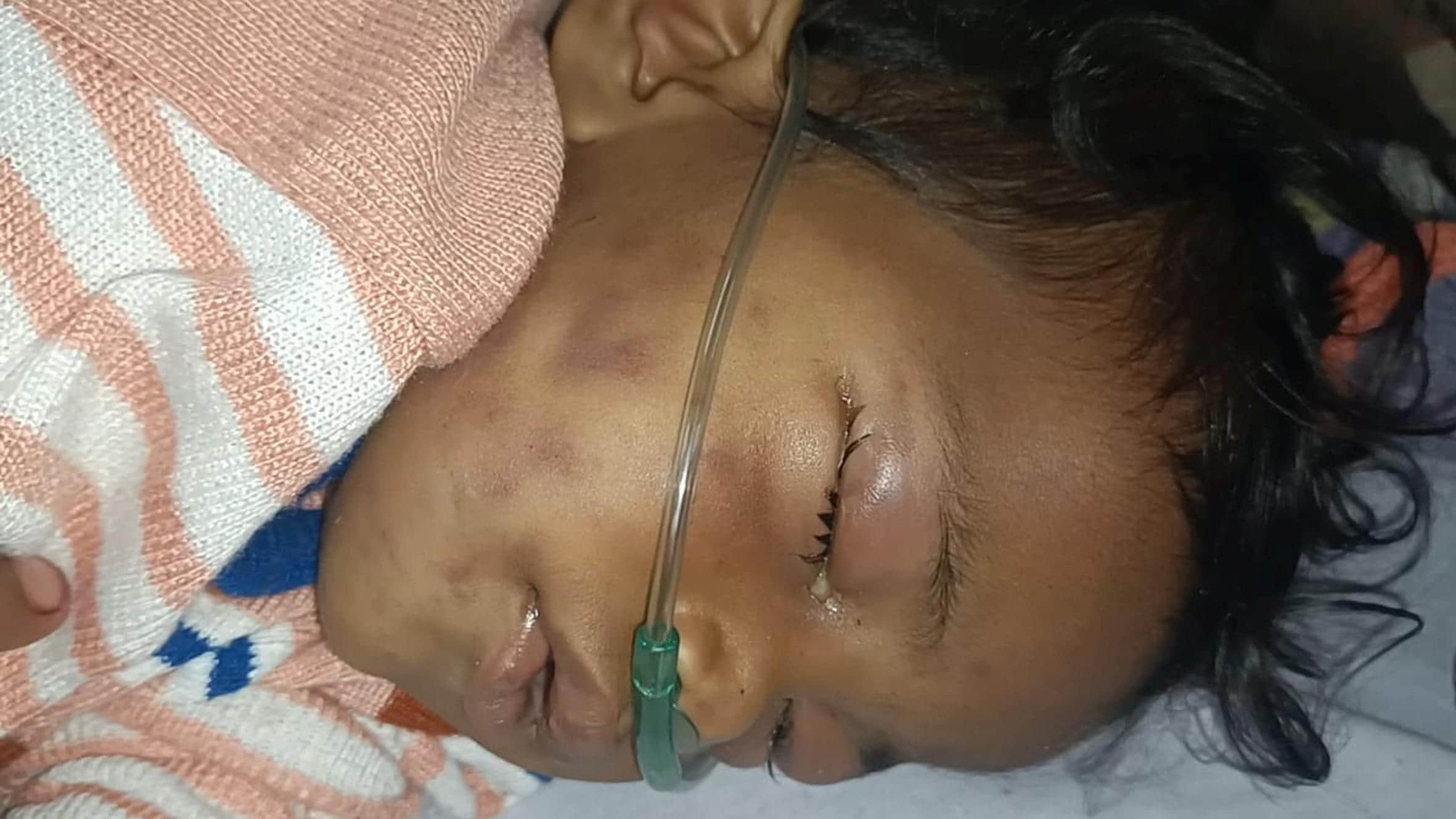 मधुमक्खी के हमले में घायल अंकुल।