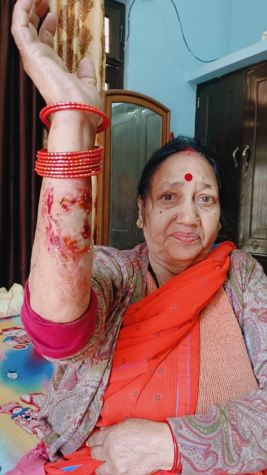 Fifteen people, including the councilor's brother, were bitten by stray dogs.