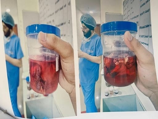 Sponge strip was left in woman's stomach during operation, FIR registered against five doctors