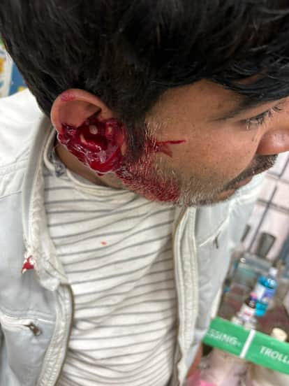 Monkeys attacked two people at the hospital, biting their lips and ears.