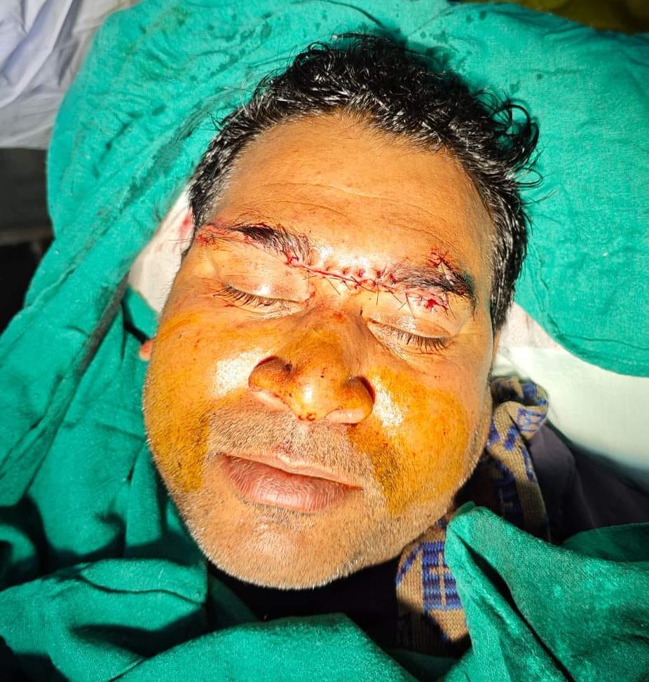 Chinese manjha cuts lab technician's forehead, requires 16 stitches