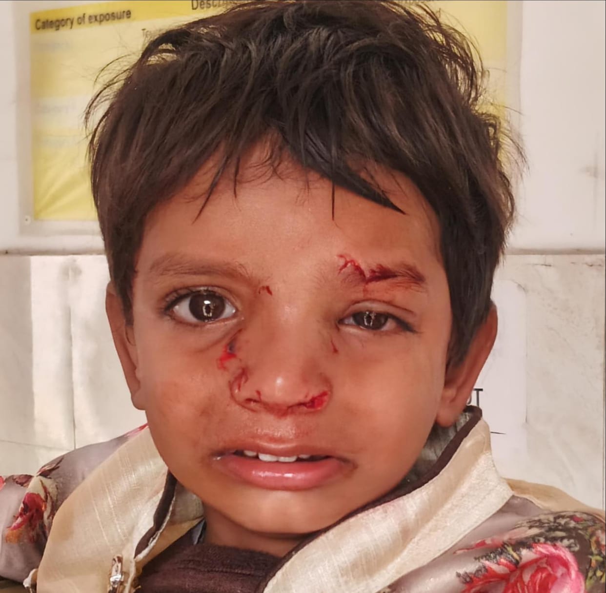 Four-year-old girl injured in monkey attack