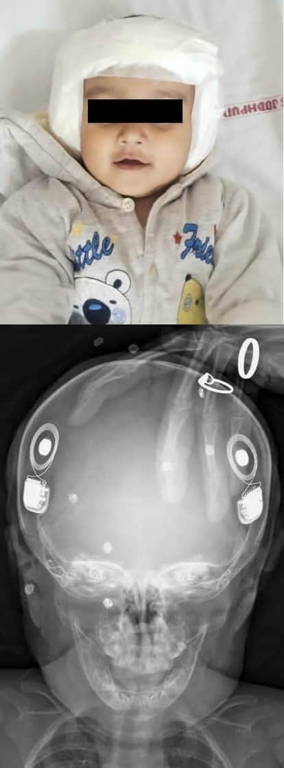 AIIMS Jodhpur created history by implanting two ears of  9 month old girl in single surgery