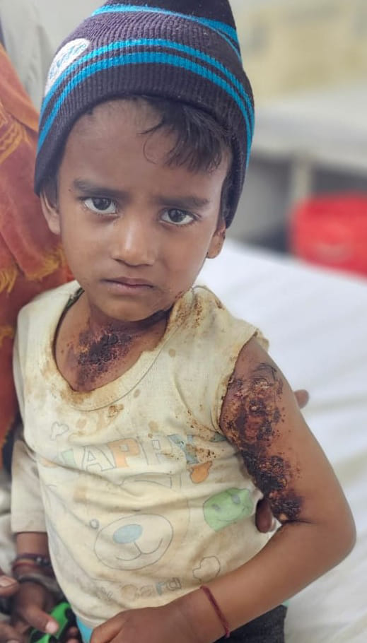 Innocent girl gets scalded after falling on boiling tea pot