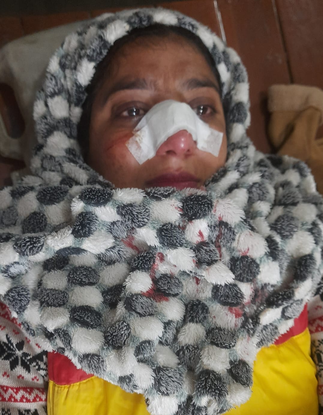 A young woman riding a scooter sustained injuries on her nose due to Chinese manjha on Meerut-Baghpat highway.