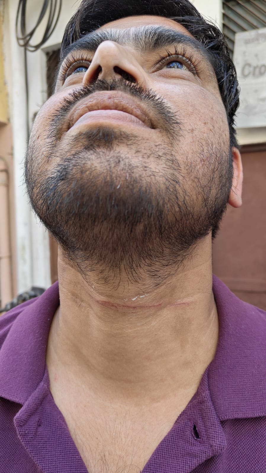 Manjha stuck in the neck... bike rider applied brakes, wife and daughter also injured