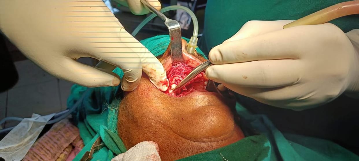 First oral cancer operation in Civil Hospital, lump removed