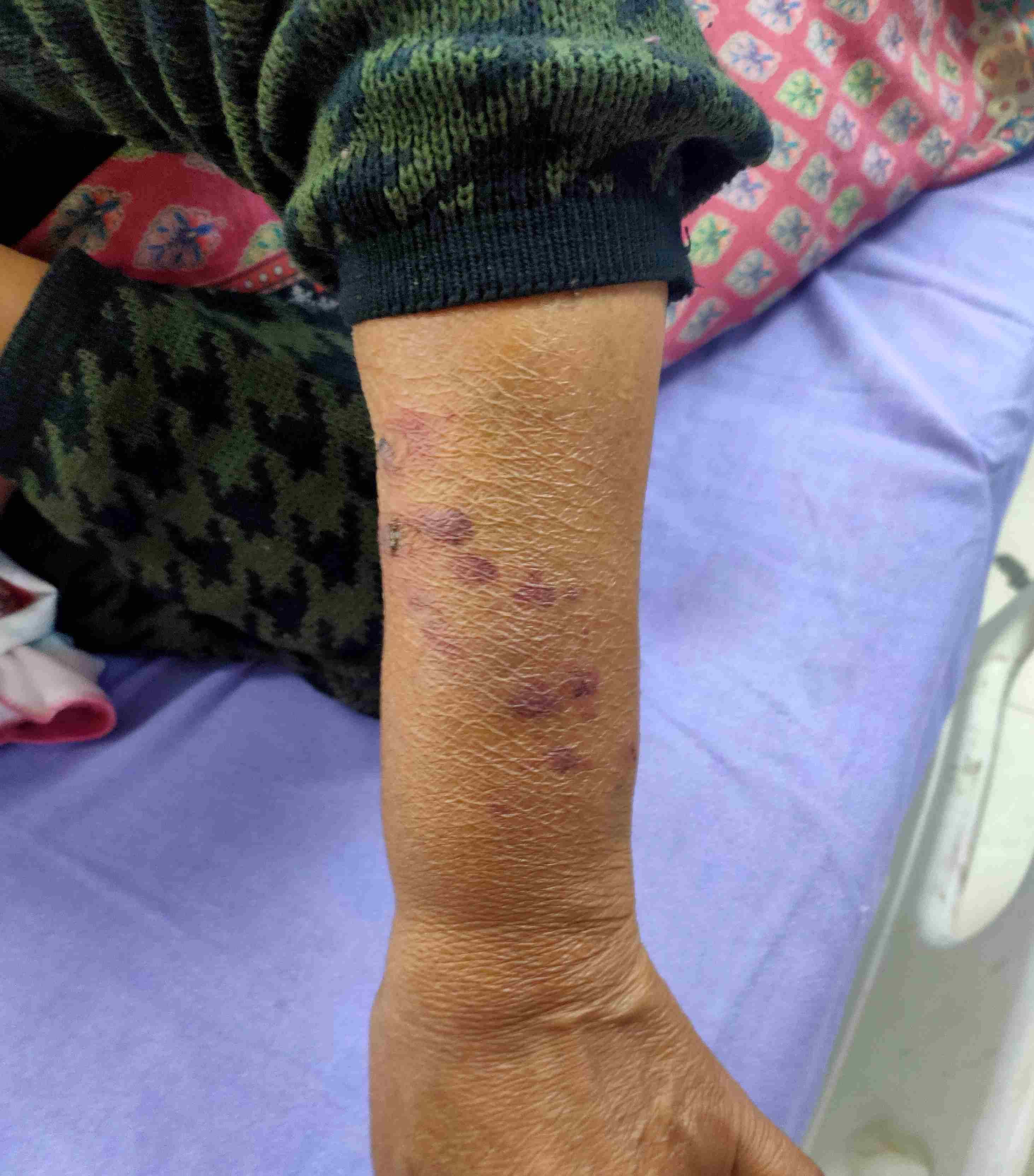 महिला हाथ पर चोट के निशान दिखती हुई। 