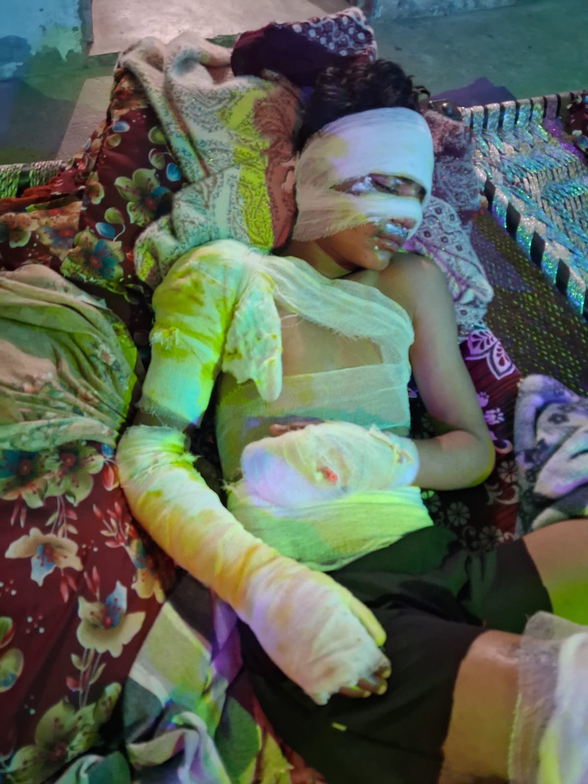 Two teenagers were badly burnt by chemical, their condition is critical